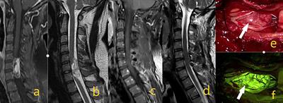 Sodium Fluorescein for Spinal Intradural Tumors